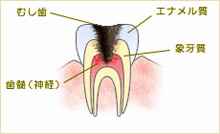 C3　神経のむし歯