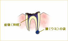 C4　末期のむし歯